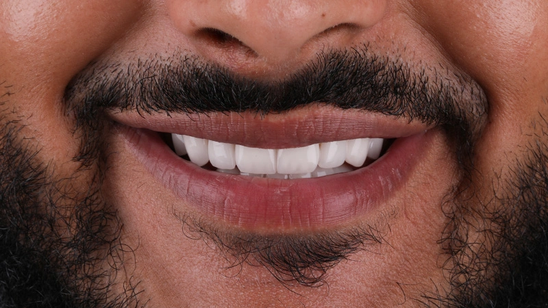After Veneers